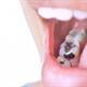 عوارض و مراقبت‌های بعد از پر کردن دندان‌ها چیست؟